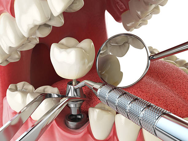 Best Root Canal Emergency Dentist  in Bystrom, CA